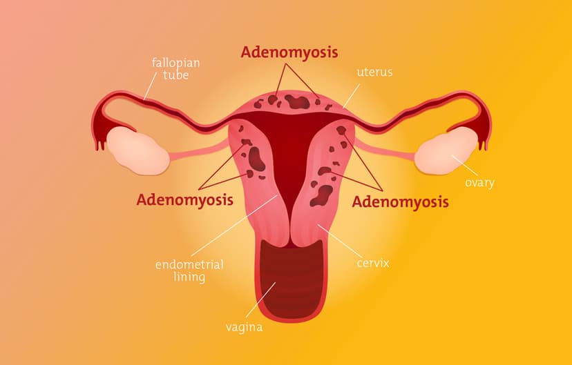 Adenomyosis: Recognizing Symptoms and Treatment for Womens Health