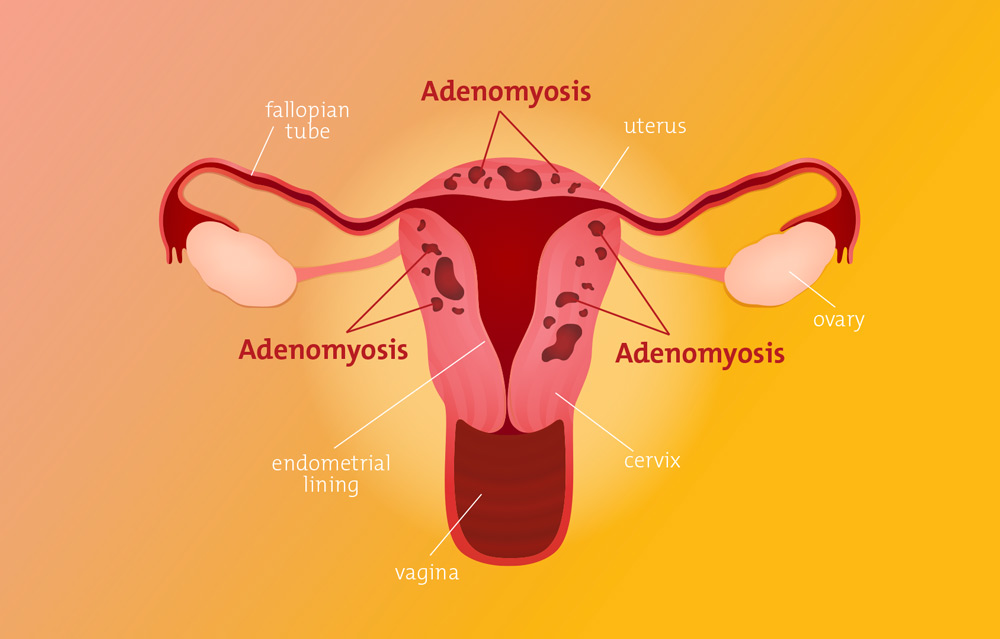 Adenomyosis: Recognizing Symptoms and Treatment for Womens Health