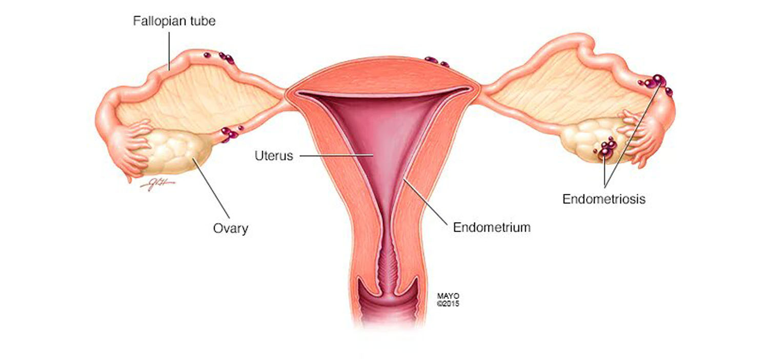 Endometriosis: Understanding The Impact On Fertility And Treatment Options