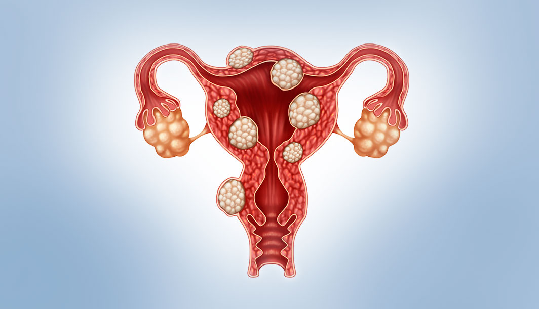 Uterine Fibroids: How They Affect Fertility and Available Treatment Options